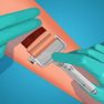 Skin Grafting Surgery